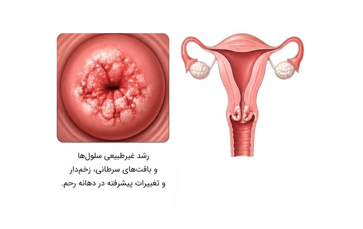  سرطان دهانه رحم 