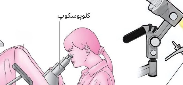 کولپوسکوپی
