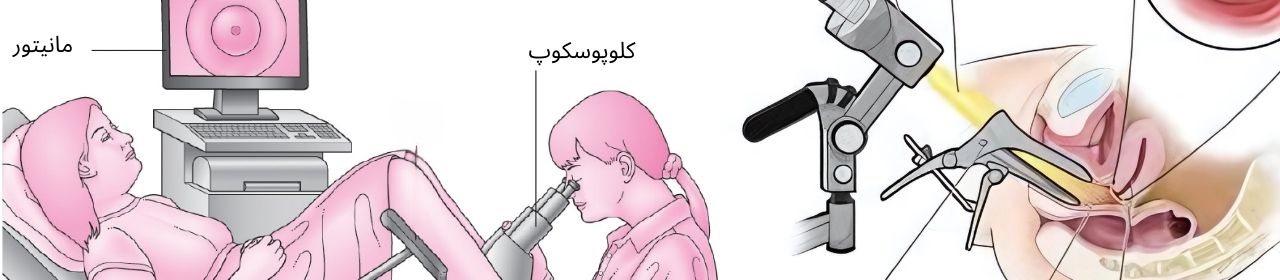 کولپوسکوپی